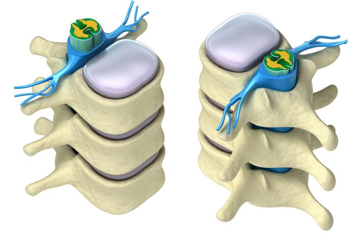 Spine surgey